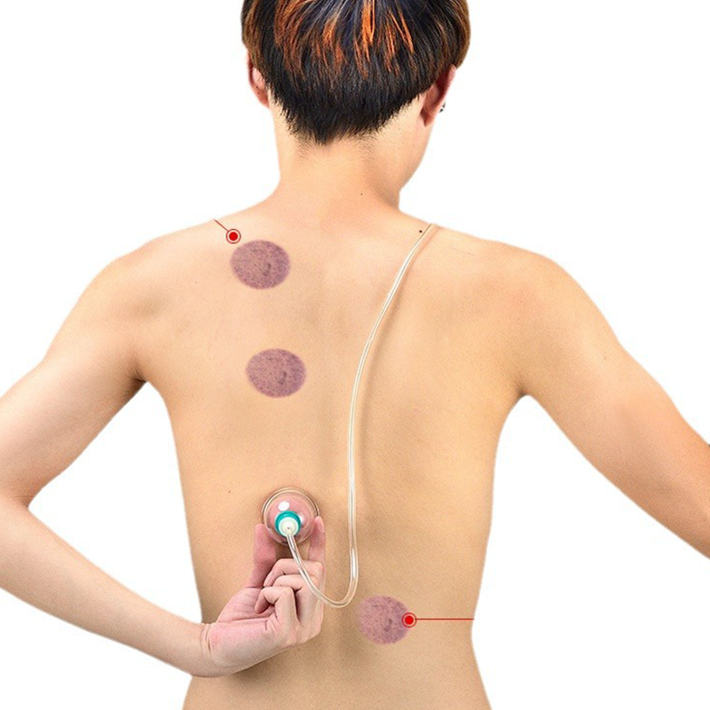 ⏳Time-Limited Special⏰Vacuum Cupping Therapy Set – Thickened, Suction Pump, Transparent 🩺